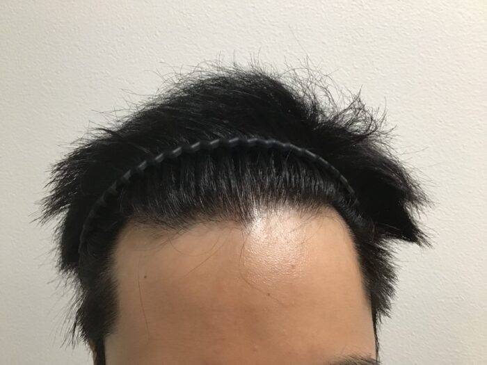 【32歳男性】生え際の後退と頭頂部の薄毛がAGA治療で改善｜千葉津田沼院