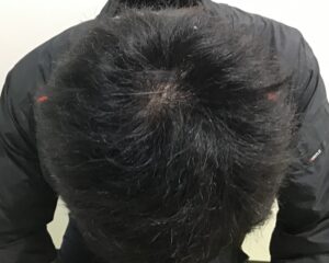 AGA治療前　32歳男性　頭頂部薄毛　千葉津田沼院