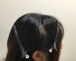 単発型円形脱毛症治療3ヶ月後　26歳女性　側頭部　単発型円形脱毛　千葉津田沼院