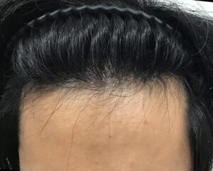 AGA治療3ヶ月後　32歳男性　生え際薄毛　千葉津田沼院