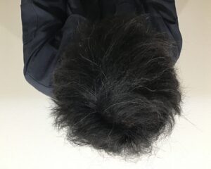AGA治療3ヶ月後　32歳男性　頭頂部薄毛　千葉津田沼院