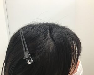 単発型円形脱毛症治療5ヶ月後　26歳女性　側頭部　単発型円形脱毛　千葉津田沼院