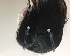 単発型円形脱毛症治療6ヶ月後　26歳女性　側頭部　単発型円形脱毛　千葉津田沼院