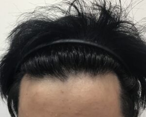 AGA治療6ヶ月後　32歳男性　生え際薄毛改善　千葉津田沼院
