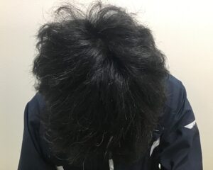 AGA治療6ヶ月後　32歳男性　頭頂部薄毛改善　千葉津田沼院