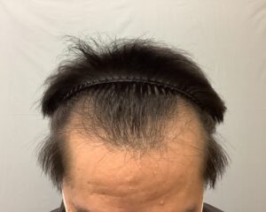 AGA治療前　49歳男性　生え際・頭頂部薄毛　金沢院