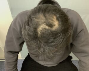 AGA治療前　49歳男性　生え際・頭頂部薄毛　金沢院