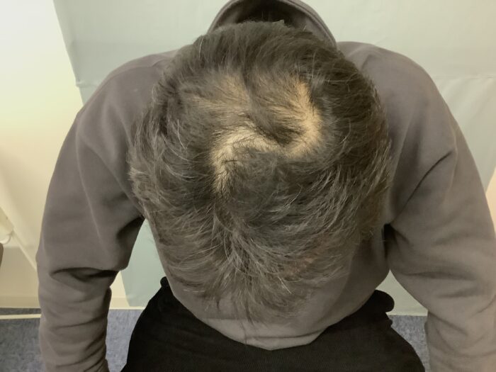 【途中経過】【49歳男性】生え際と頭頂部の薄毛がAGA治療で改善｜金沢院