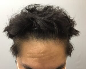 AGA治療6カ月後　49歳男性　生え際・頭頂部改善　金沢院