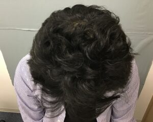 AGA治療6カ月後　49歳男性　生え際・頭頂部改善　金沢院