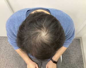 AGA治療前　30歳男性　前頭・頭頂部薄毛　新潟院