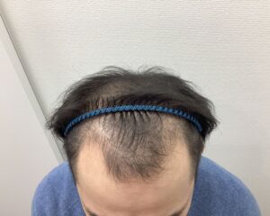 AGA治療前　30歳男性　前頭・頭頂部薄毛　新潟院