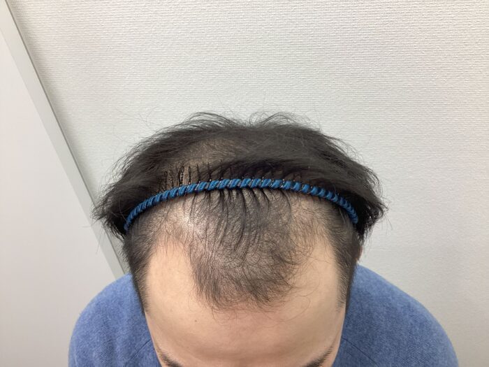 【30歳男性】前頭・頭頂部の薄毛がAGA治療で改善｜新潟院