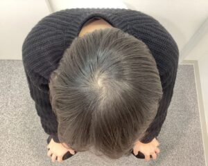 AGA治療前 29歳男性 前頭・頭頂部薄毛 新潟院