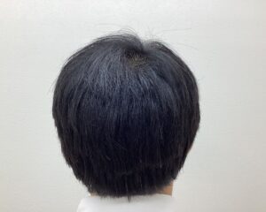 AGA治療3ヵ月目　43歳男性　頭頂部薄毛　横浜院