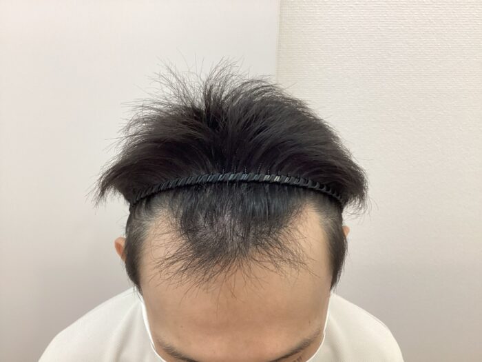 【35歳男性】生え際の薄毛がAGA治療で改善｜新潟院