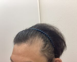 AGA治療前　47歳男性　生え際・頭頂部薄毛　新潟院