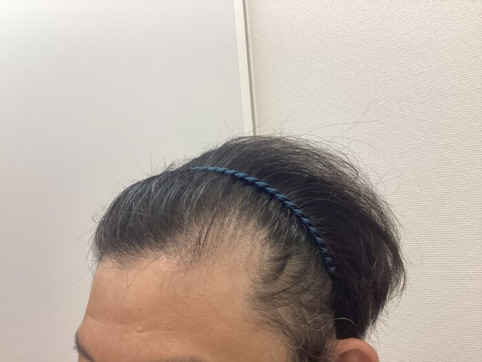 【47歳男性】生え際・頭頂部の薄毛がAGA治療で改善中｜新潟院