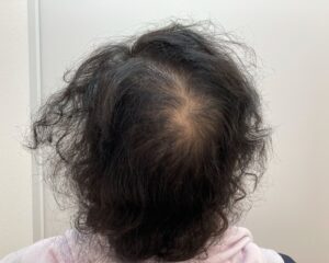 AGA治療前　42歳女性　側頭部・頭頂部薄毛　新潟院