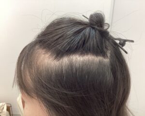 AGA治療前　24歳女性　生え際・分け目薄毛　新潟院