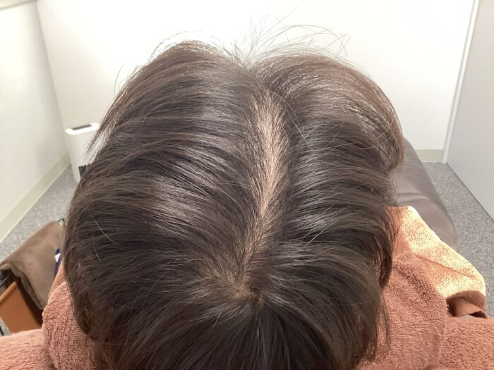 【29歳男性】前頭・頭頂部の薄毛がAGA治療で改善｜新潟院