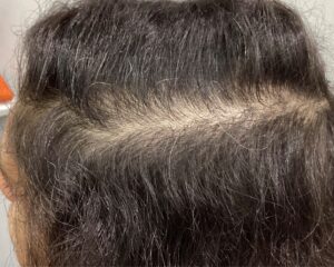 FAGA1年後　42歳女性　側頭部・頭頂部改善中　新潟院