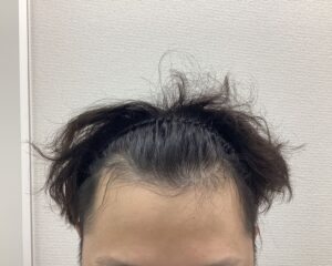 AGA治療前　31歳男性　生え際薄毛　新潟院