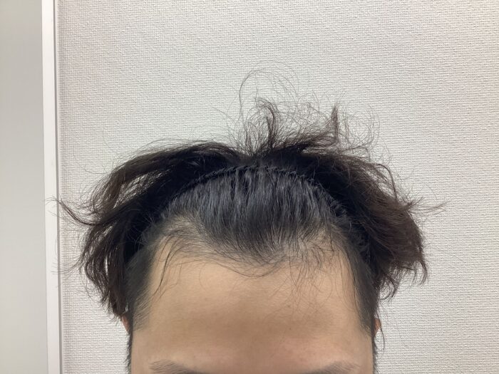 【31歳男性】生え際の薄毛がAGA治療で改善中｜新潟院