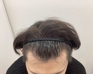 AGA治療前 29歳男性 前頭・頭頂部薄毛 新潟院