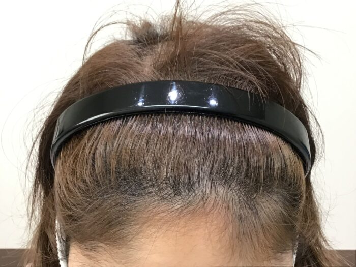 FAGA治療開始3ヶ月経過　38歳女性　生え際薄毛　鹿児島院