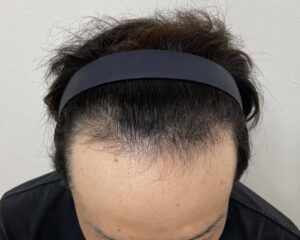 AGA治療前　29歳男性　生え際・頭頂部薄毛　岡山院