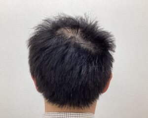 AGA治療前　43歳男性　頭頂部薄毛　横浜院