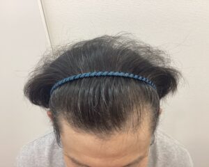 AGA治療前　47歳男性　生え際・頭頂部薄毛　新潟院