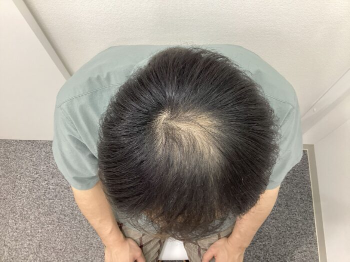 【32歳男性】前頭・頭頂部の薄毛がAGA治療で改善中｜新潟院