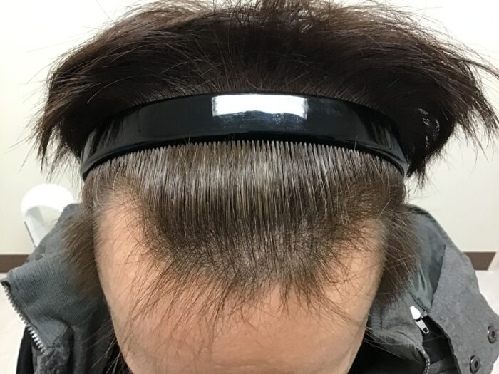 AGA治療前 46歳男性 生え際薄毛 鹿児島院