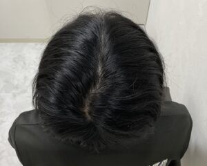 AGA治療9ヵ月後　29歳男性　生え際・頭頂部薄毛　岡山院
