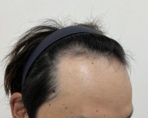 AGA治療前　29歳男性　生え際・頭頂部薄毛　岡山院