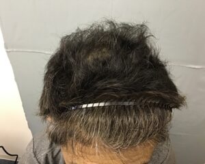 AGA治療後　43歳男性　生え際・頭頂部薄毛　金沢院