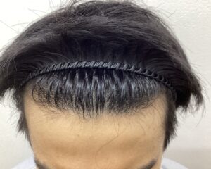 AGA治療9ヵ月経過　27歳男性　生え際　横浜院