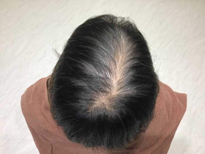 FAGA治療前　38歳女性　分け目薄毛　鹿児島院