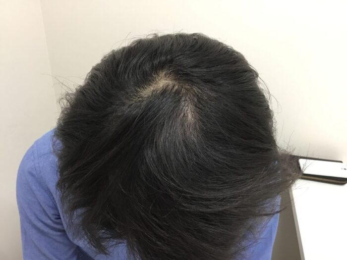 【29歳男性】生え際・頭頂部の薄毛がAGA治療で改善｜大阪梅田院