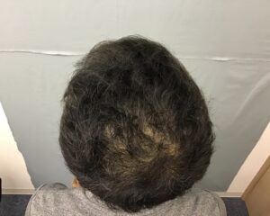 AGA治療後　43歳男性　生え際・頭頂部薄毛　金沢院