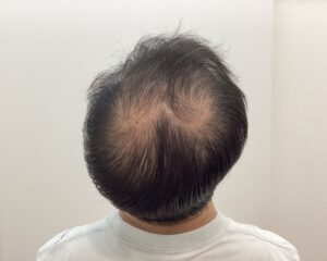 AGA治療前　43歳男性　生え際・頭頂部薄毛　新潟院