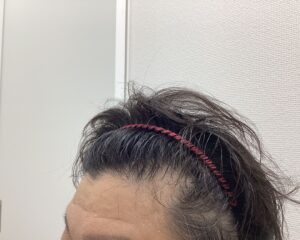 AGA治療5ヶ月後　47歳男性　生え際・頭頂部改善中　新潟院