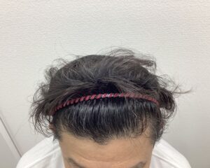 AGA治療5ヶ月後　47歳男性　生え際・頭頂部改善中　新潟院