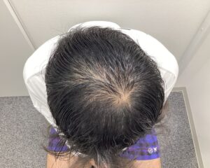 AGA治療5ヶ月後　47歳男性　生え際・頭頂部改善中　新潟院