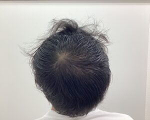 AGA治療5ヶ月後　47歳男性　生え際・頭頂部改善中　新潟院