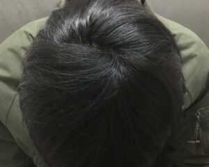 AGA治療6ヶ月後　25歳男性　頭頂部改善　京都院