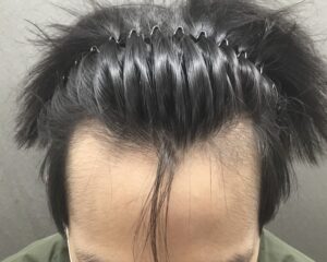 AGA治療6ヶ月後　25歳男性　生え際改善　京都院