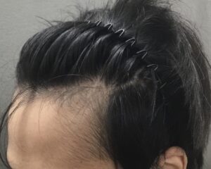 AGA治療6ヶ月後　25歳男性　生え際改善　京都院